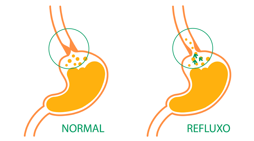 Reflux in celiac disease