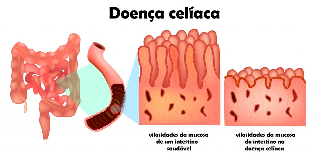 Atypical symptoms of celiac disease